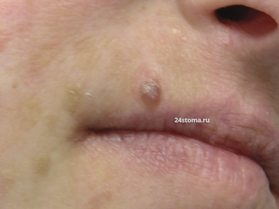 Злокачественная амеланотическая меланома на губе