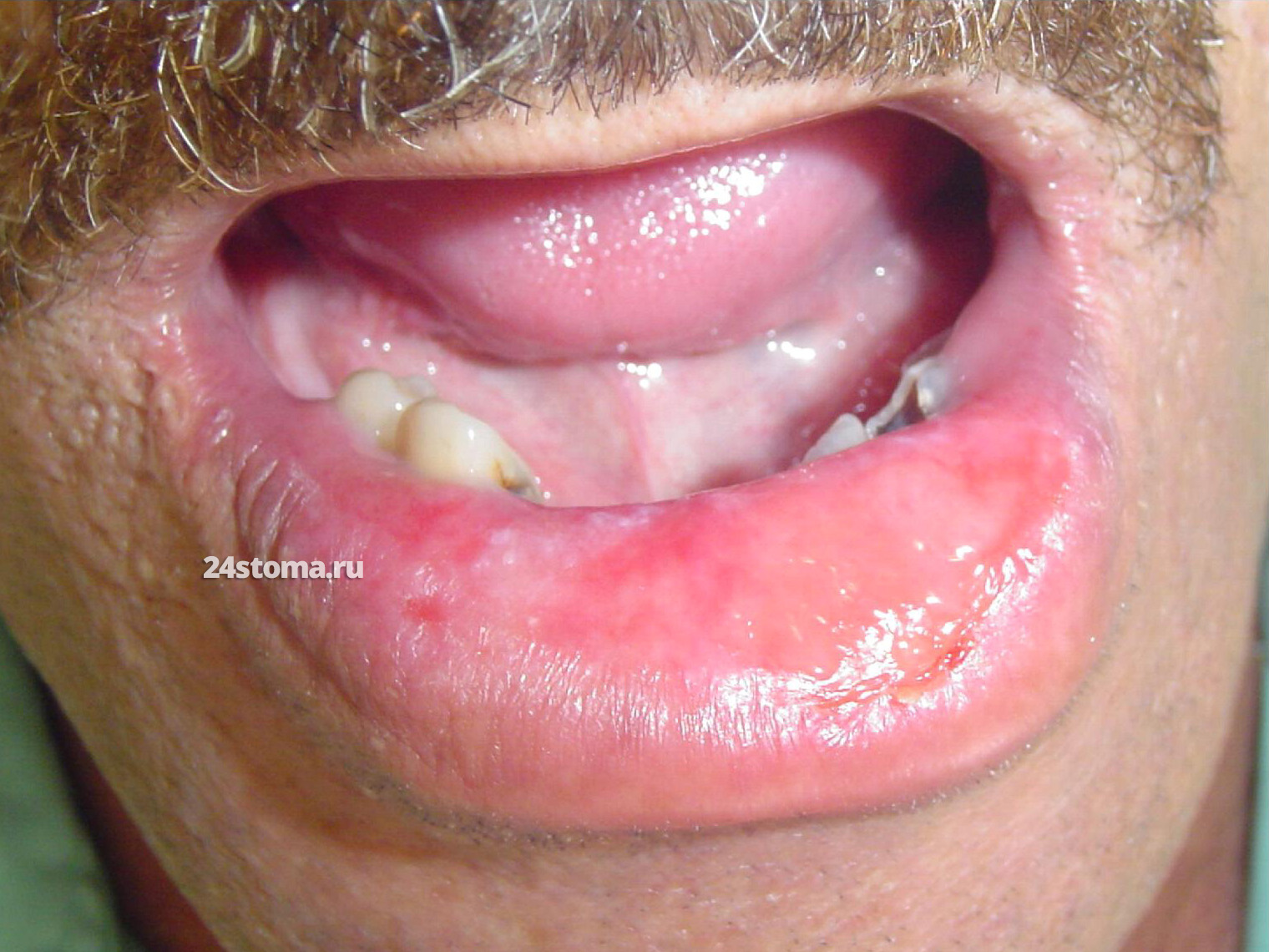 Десмопластическая меланома нижней губы