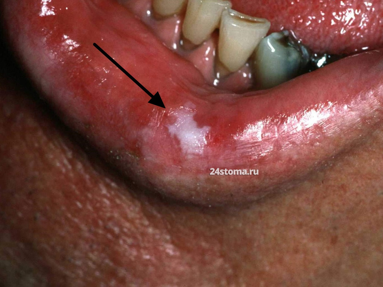 Эрозивно-язвенная форма лейкоплакии на нижней губе