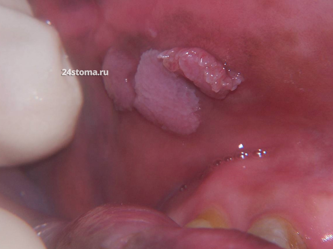 Папиллома на слизистой оболочке верхней губы