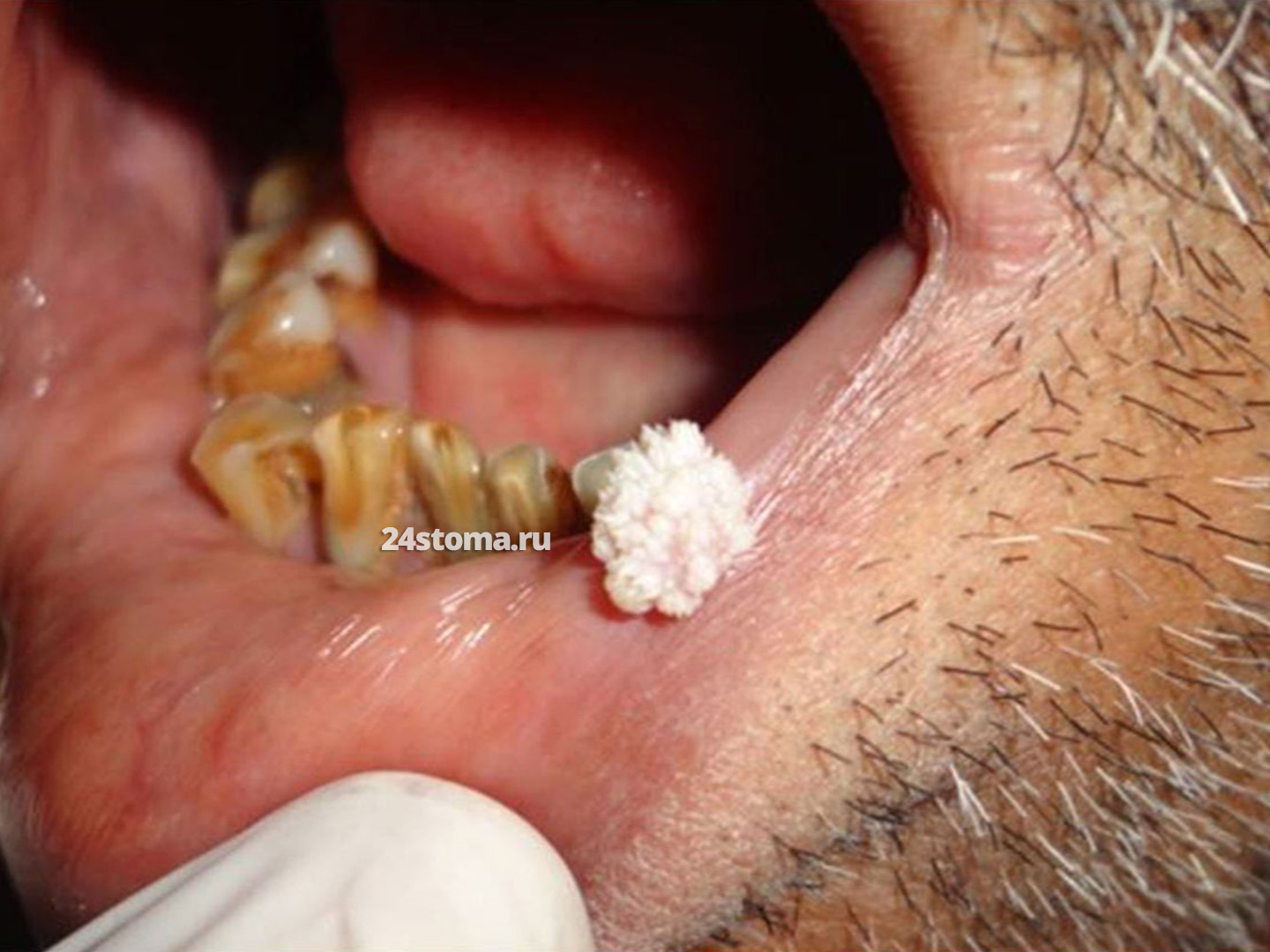 Плоскоклеточная папиллома на нижней губе.