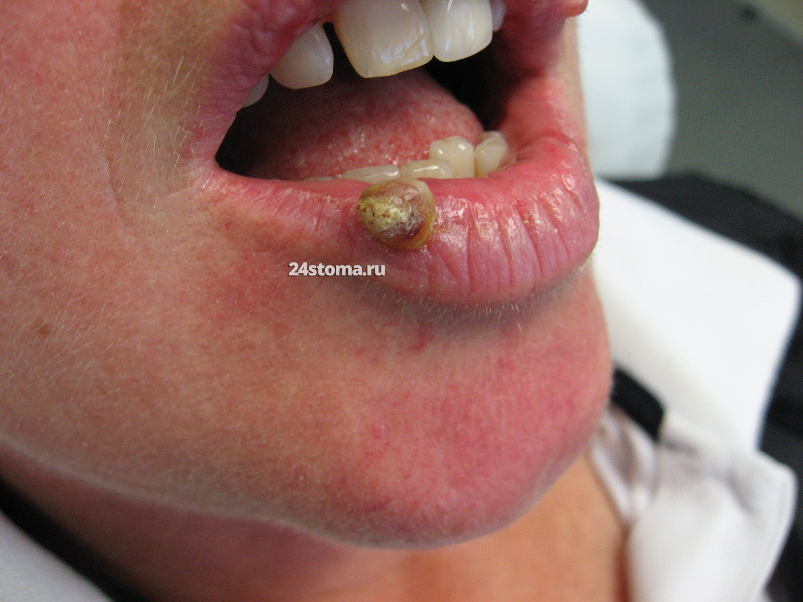 Пиогенная гранулема на нижней губе