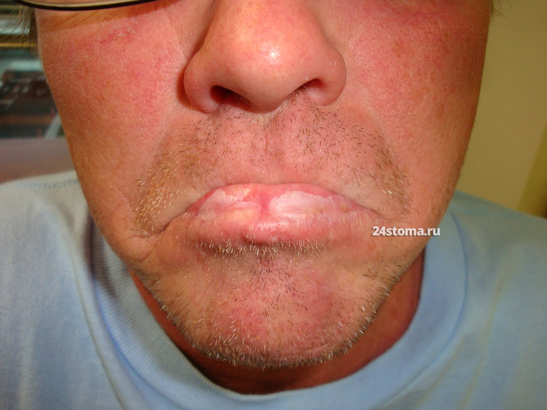 Плоская форма лейкоплакии красной каймы губ