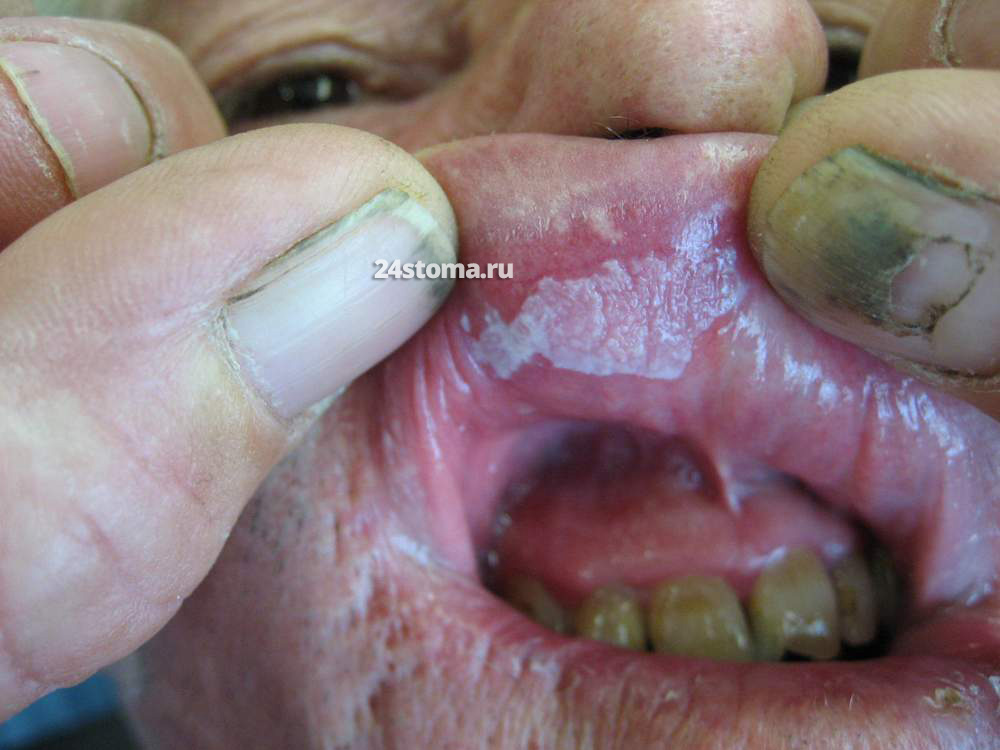 Веррукозная лейкоплакия верхней губы