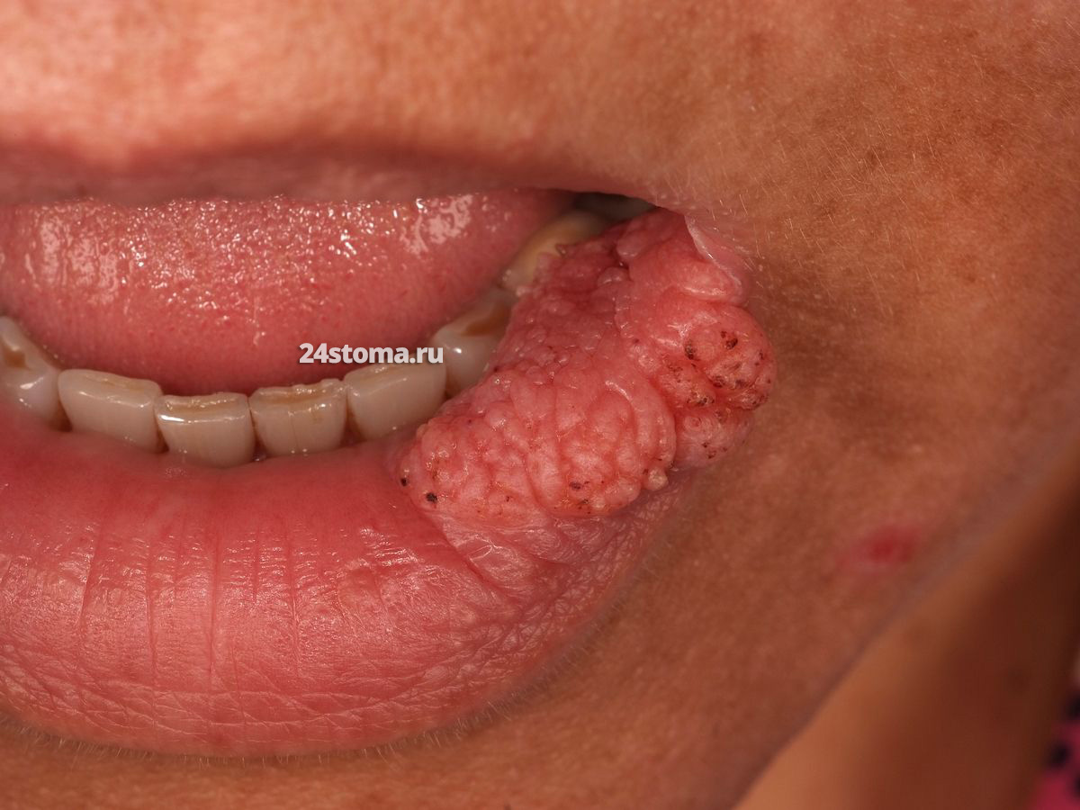 Плоскоклеточная карцинома нижней губы