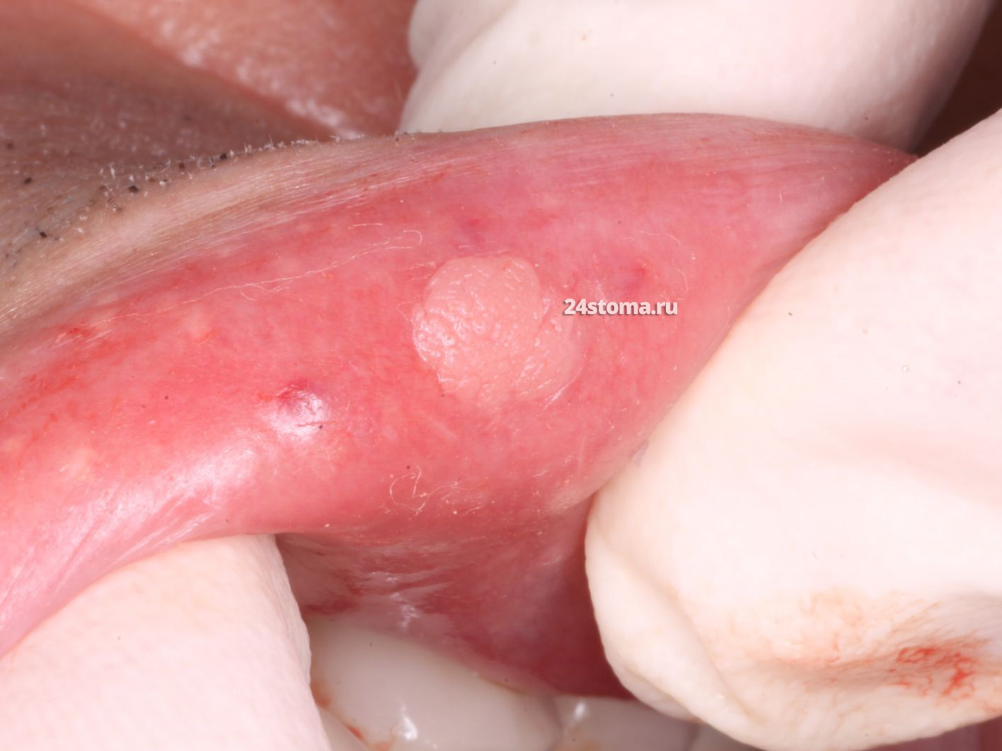 Папиллома на губе (вирус ВПЧ)