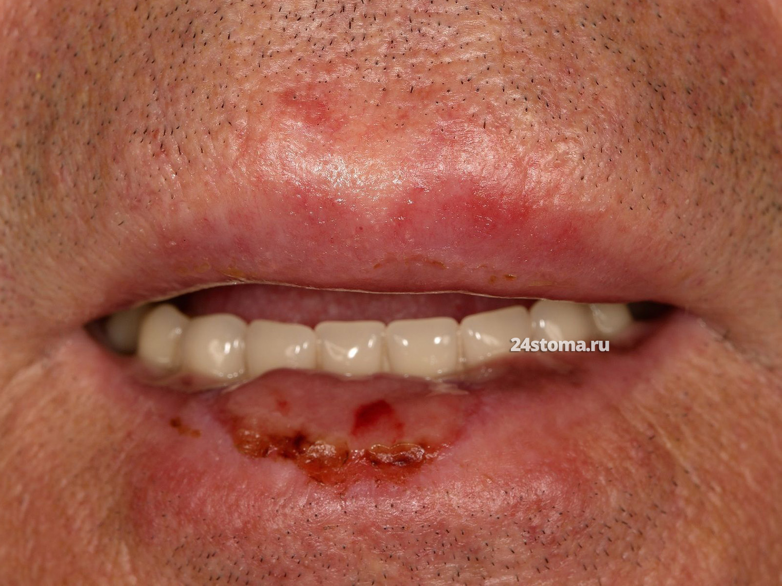 Изъязвленная инвазивная плоскоклеточная карцинома нижней губы
