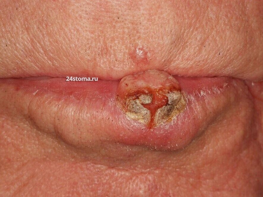 Рак верхней и нижней губы