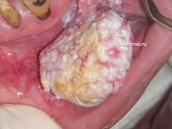 Веррукозная карцинома на слизистой внутренней поверхности губы