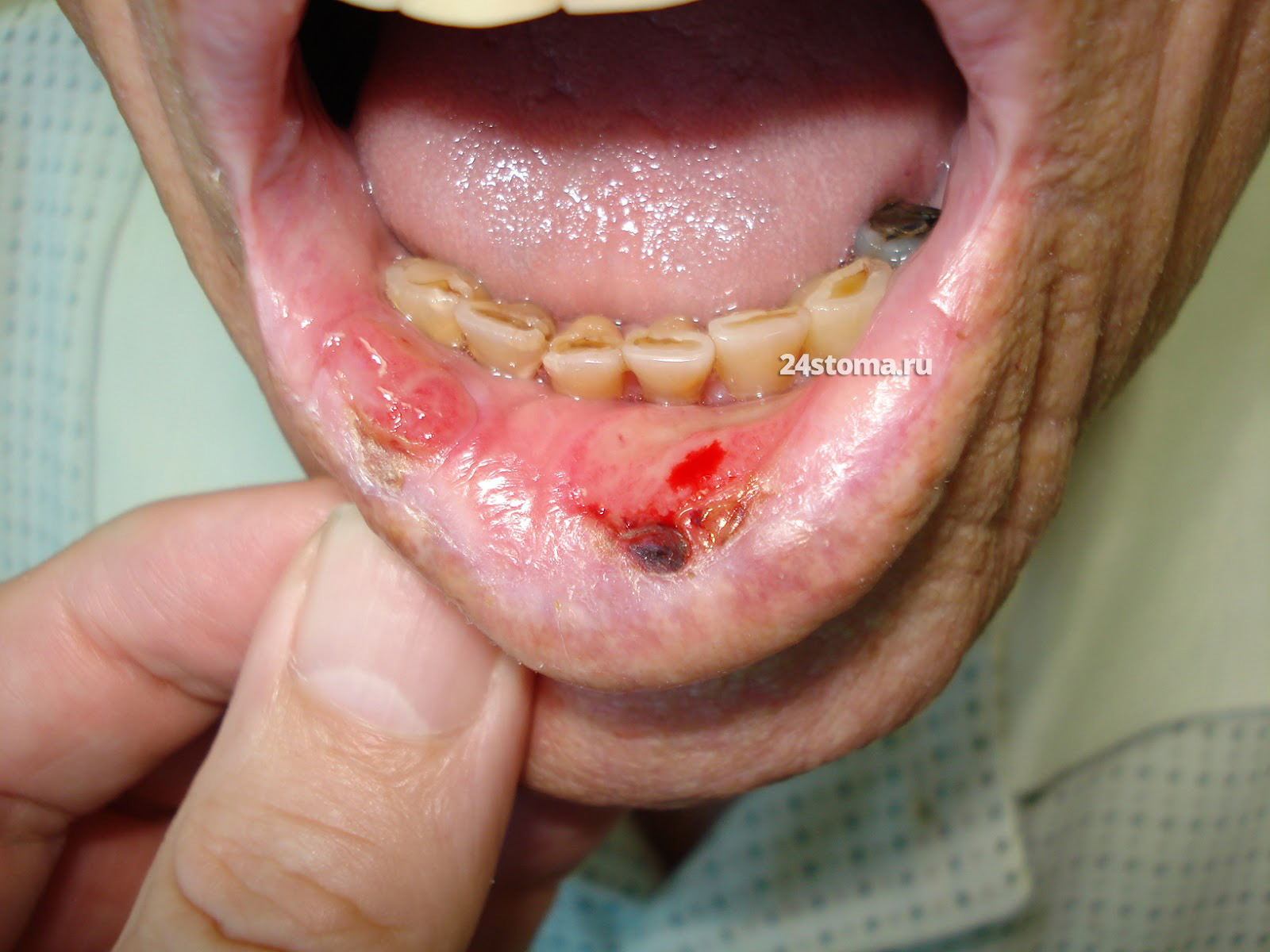 Плоскоклеточный рак нижней губы (плоскоклеточная карцинома)