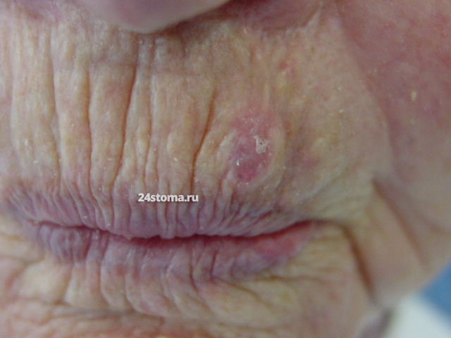 Базальноклеточный рак верхней губы (базальноклеточная карцинома)
