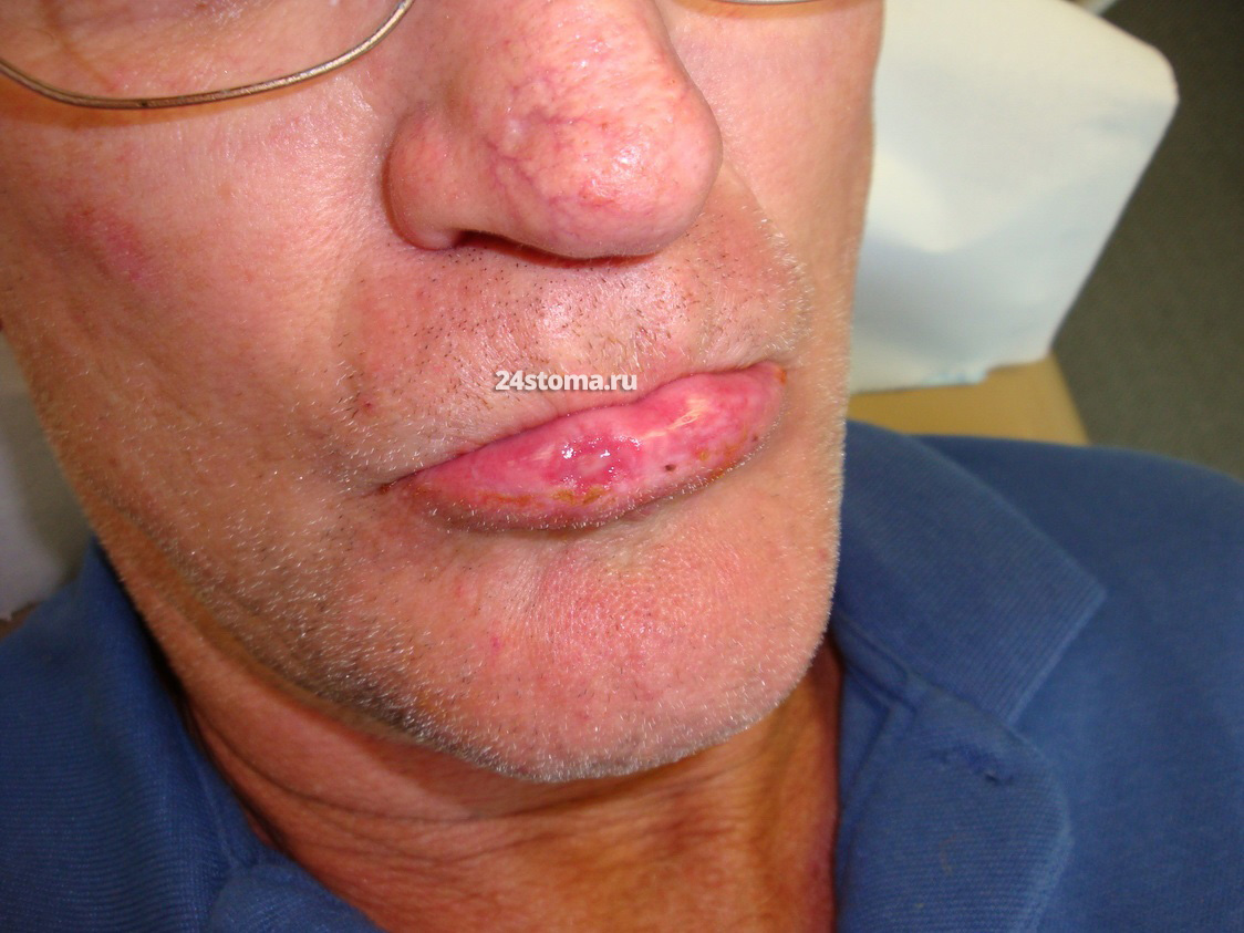 Эритроплакия на нижней губе