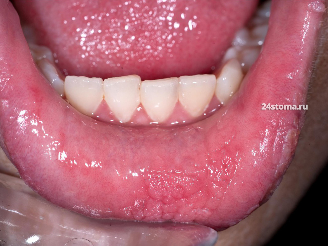 Эпителиальная гиперплазия на слизистой оболочке нижней губы у пациента с системным кератотическим невусом.